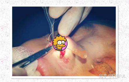 鼻综合手术的第七步是进行鼻翼软骨贯穿缝合和软骨间缝合,随后爱美者