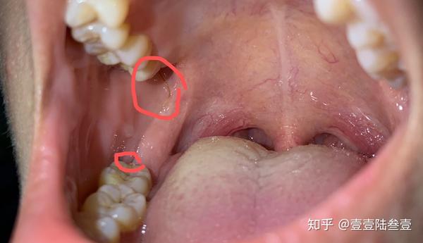 拔完智齿胶原蛋白线 拔智齿后胶原蛋白 Duboot网