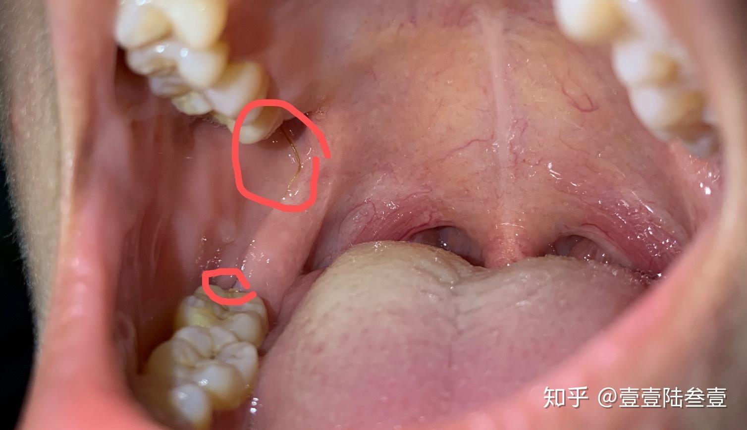 拔完智齿 胶原蛋白线 - 知乎