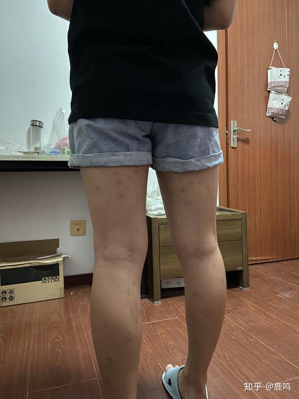 被蚊子咬了青紫淤血 腿被蚊子咬后淤血一大块 腿上被蚊子咬了后淤青