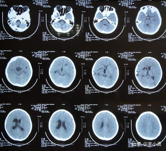 颅脑火器外伤后1年内2次脑室引流 颅内异物取出术,又脑积水严重颅内