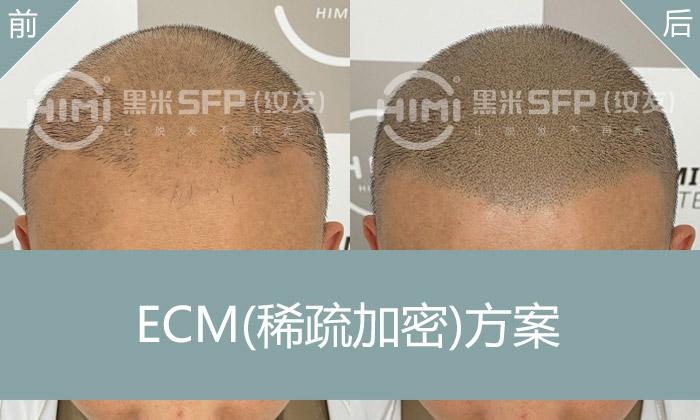 纹发案例：前额植发后纹发加密，头顶稀疏变浓密 - 知乎