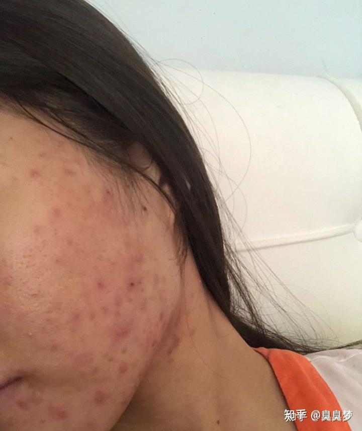 痘印会自己消吗有什么好的消除方法拯救满脸痘印呢