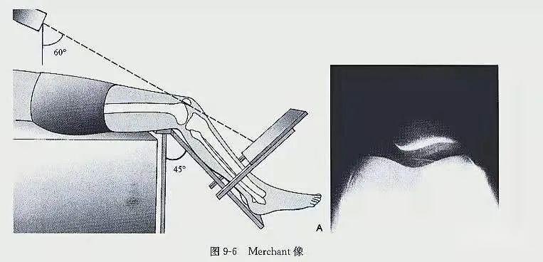 肋骨斜位的投照方法图图片