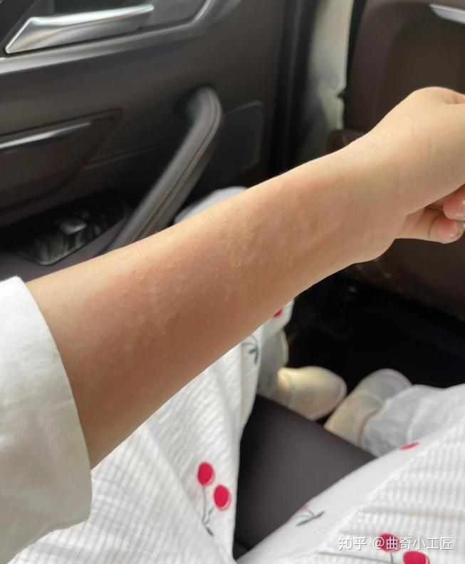皮肤瘙痒长风团怎么办?用什么药可以快速赶走荨麻疹? - 知乎
