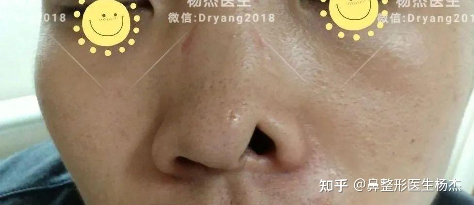 为什么鼻整形后会出现露鼻孔,该如何治疗? - 知乎