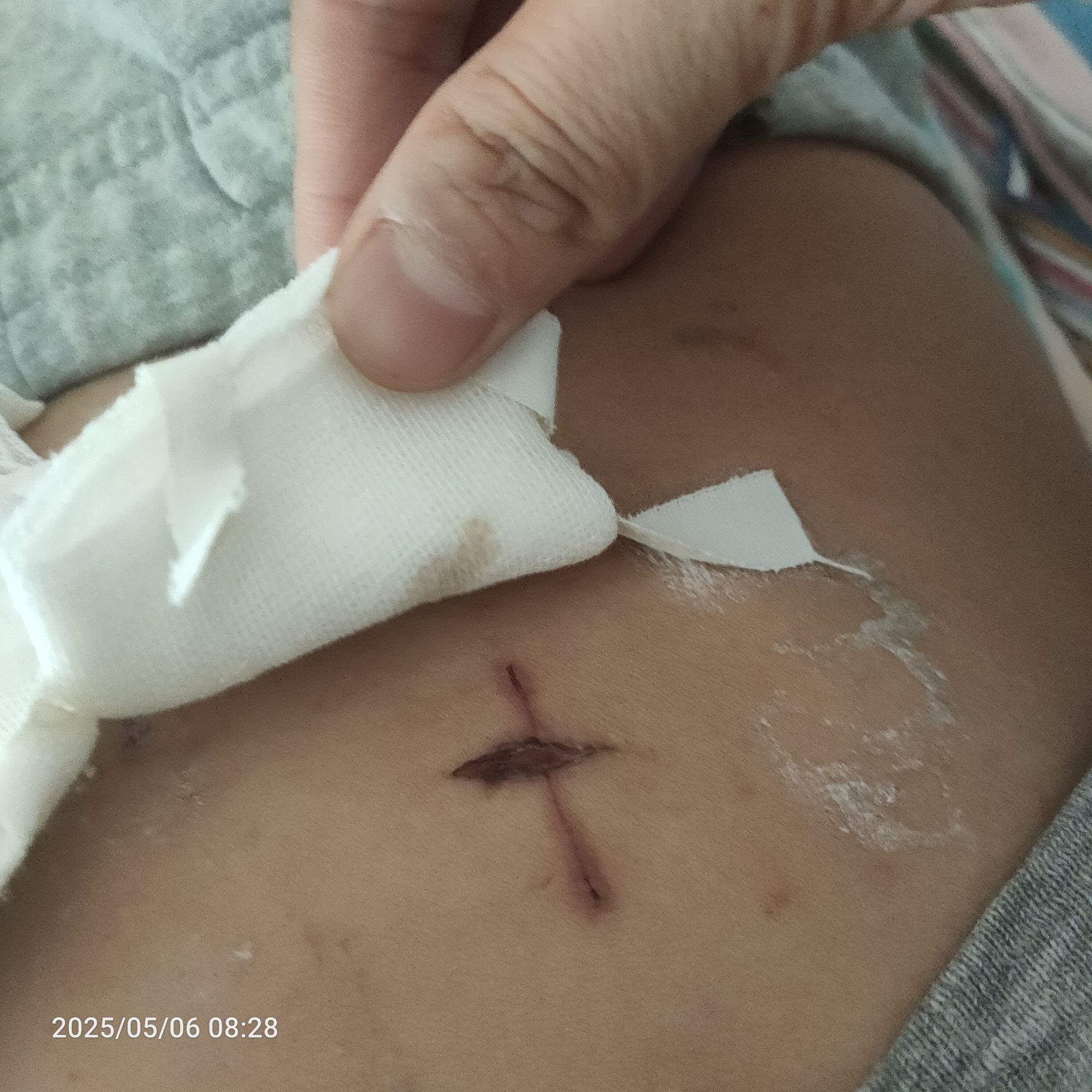 阑尾炎伤口裂开长平过程