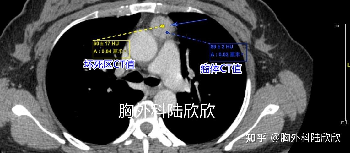 一例低危胸腺瘤的診斷治療經過