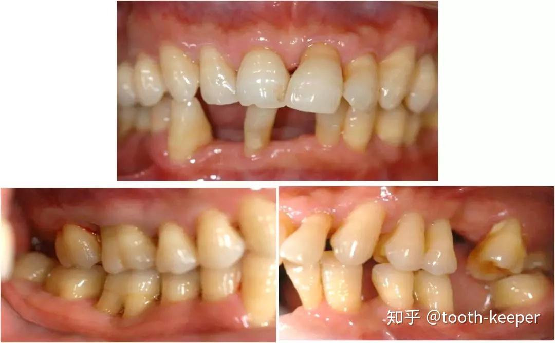 牙周治疗前后图片图片