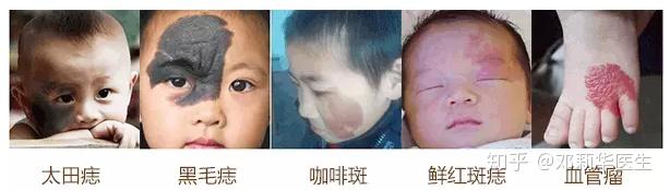 宝宝身体上经常会有的四种胎记,你知道吗? - 知乎