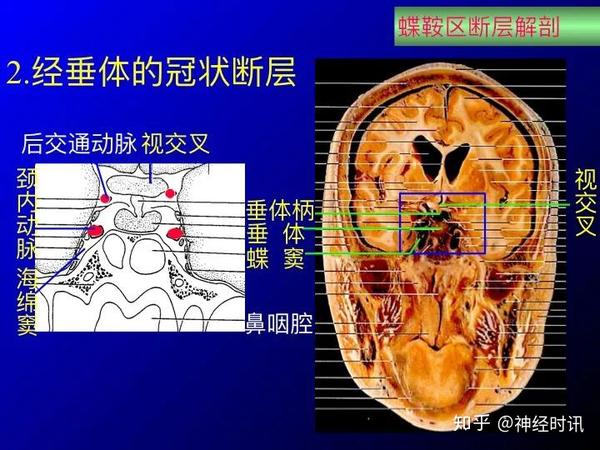 解剖&影像 蝶鞍区应用解剖+断层解剖图谱+病理影像 - 知乎