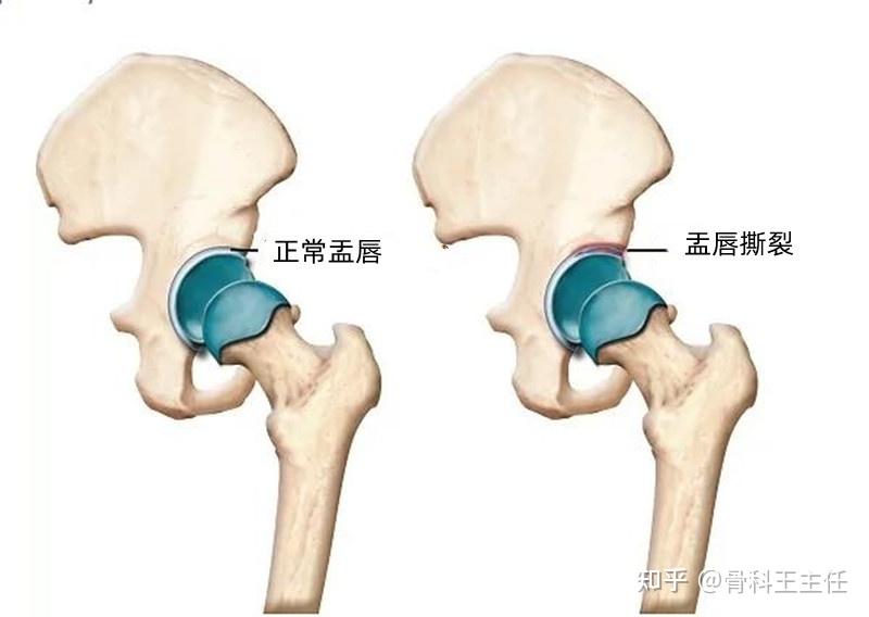 髋关节盂唇解剖图图片