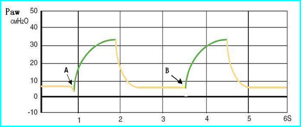 呼吸机常见波形 知乎