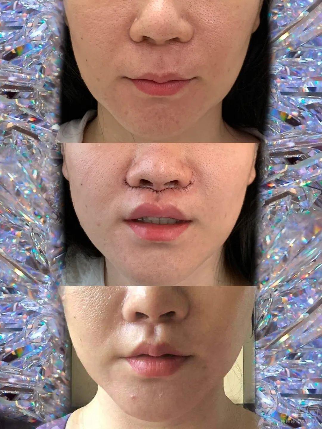施晓晓医生手术案例展示：上唇色素痣 精细缝合 美容缝合 - 好大夫在线