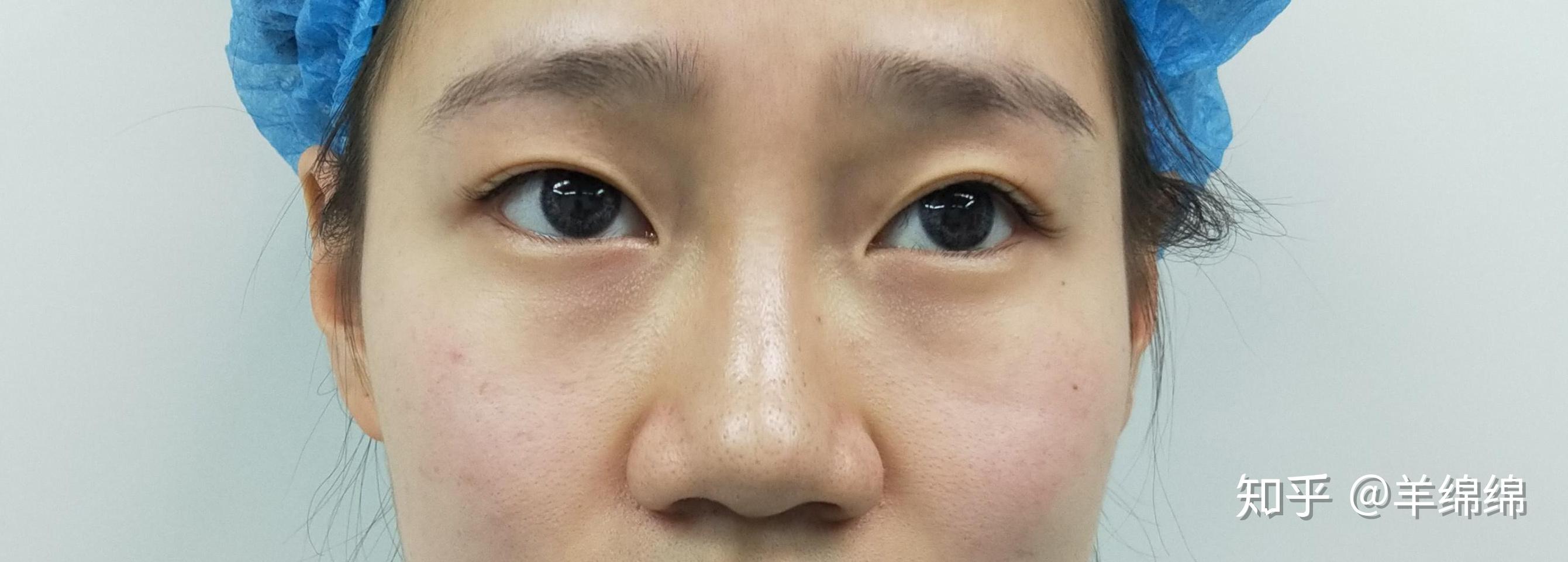 蒜头鼻该怎么整隆鼻案例分享