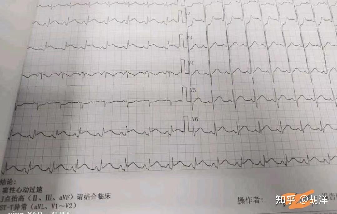 静脉注射空气死亡案例图片