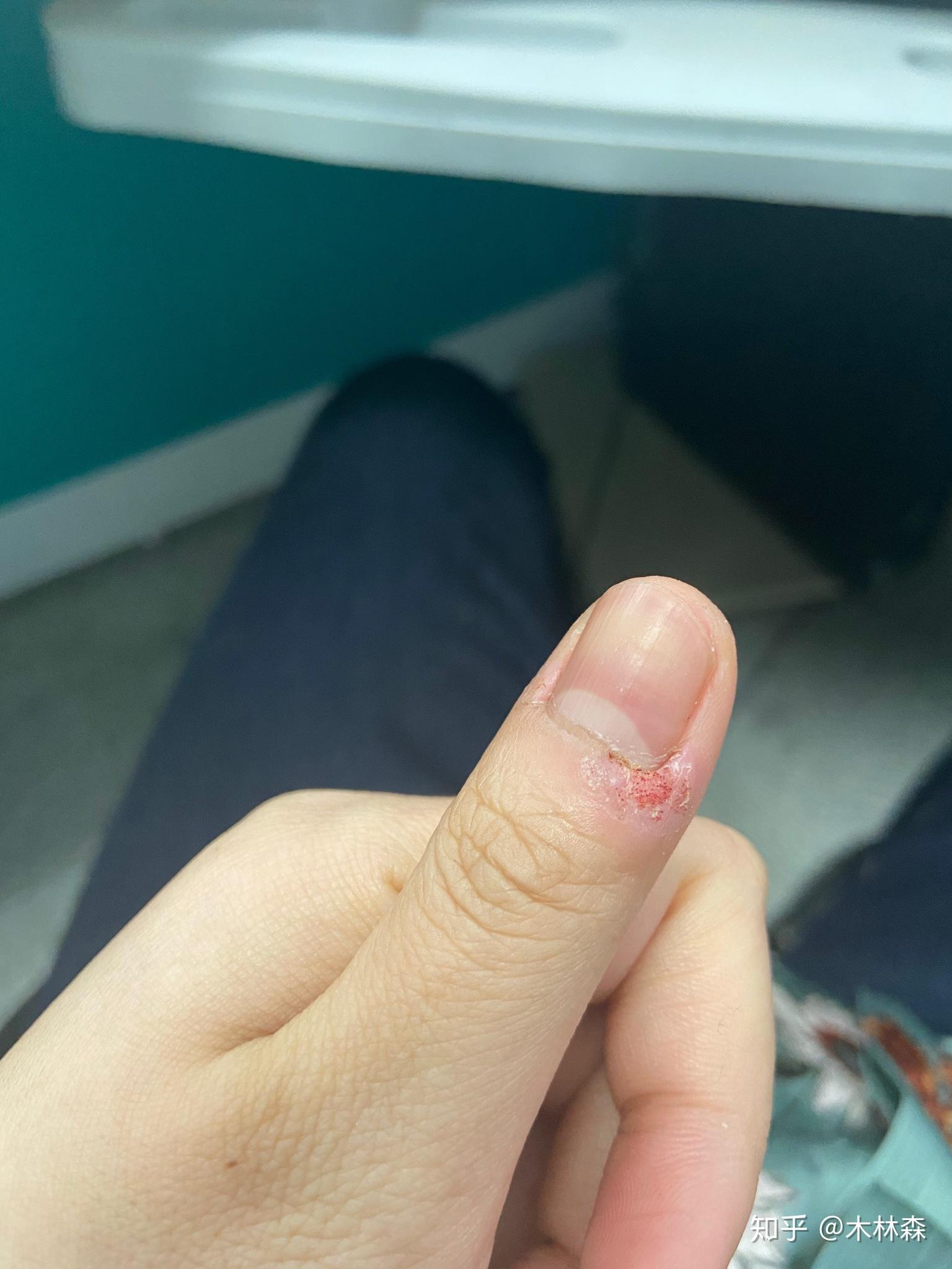 记录甲周疣治疗过程 - 知乎