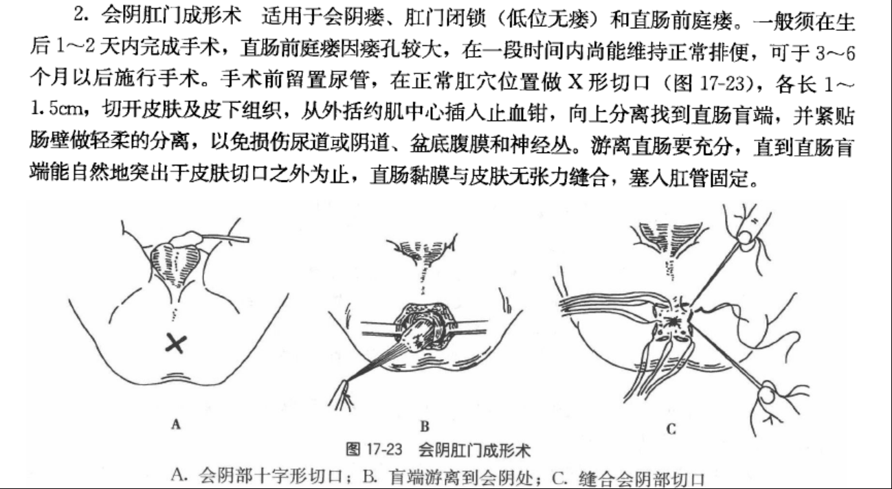 先天无肛门手术图解图片