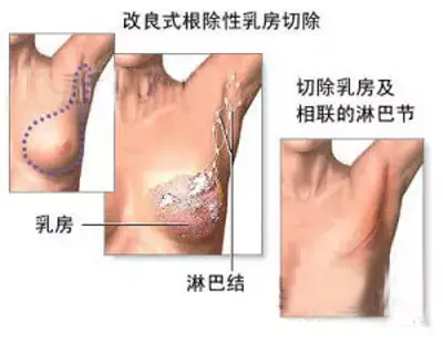 警惕 腋下长肉 可能是大病在靠近 知乎