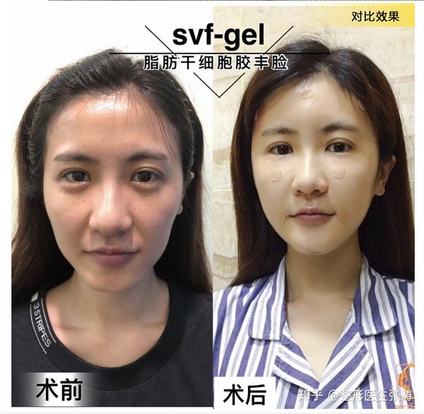 脂肪移植黑科技——SVF-gel脂肪干细胞胶 - 知乎