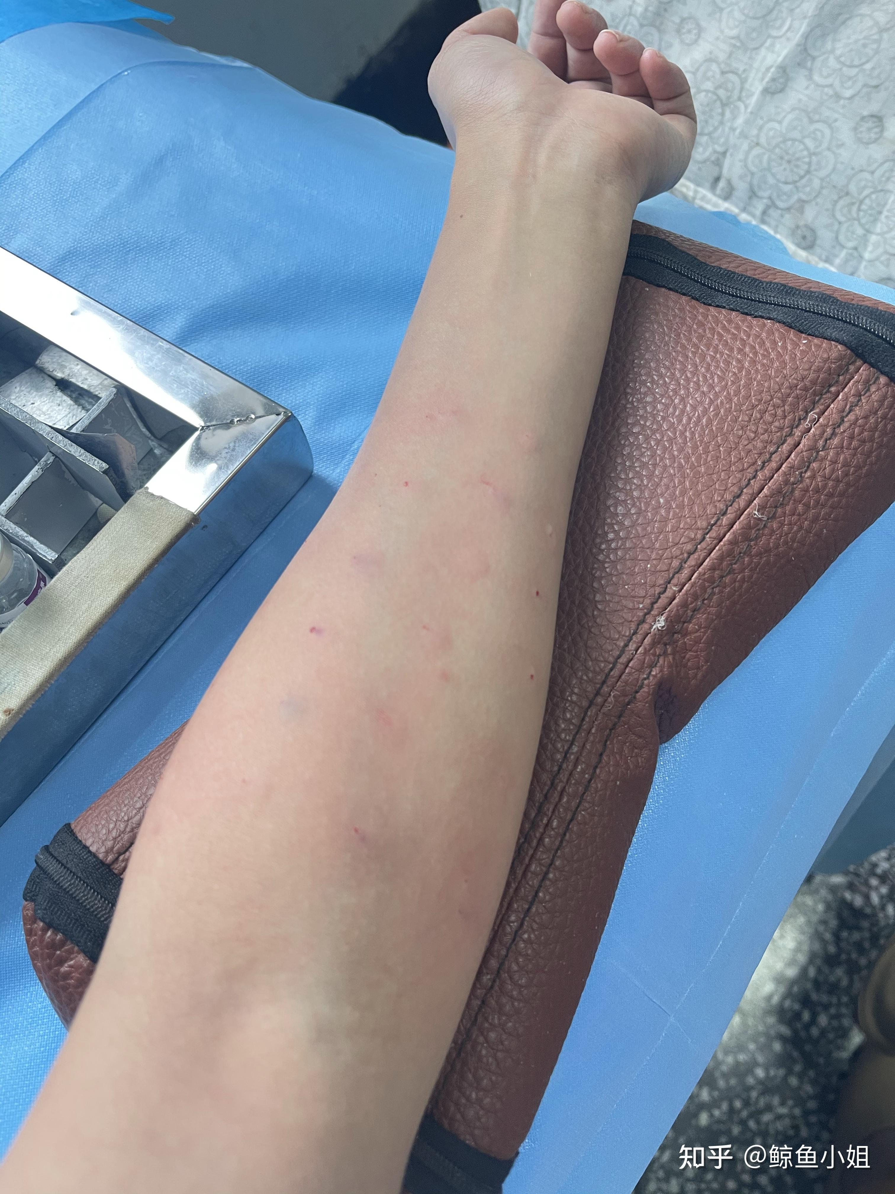 过敏性鼻炎  急性荨麻疹的脱敏治疗 - 知乎