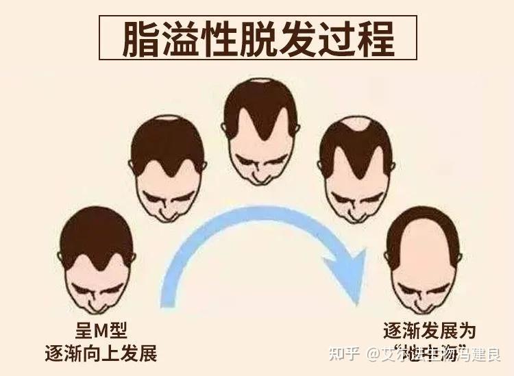 太秃然了25亿人受脱发困扰