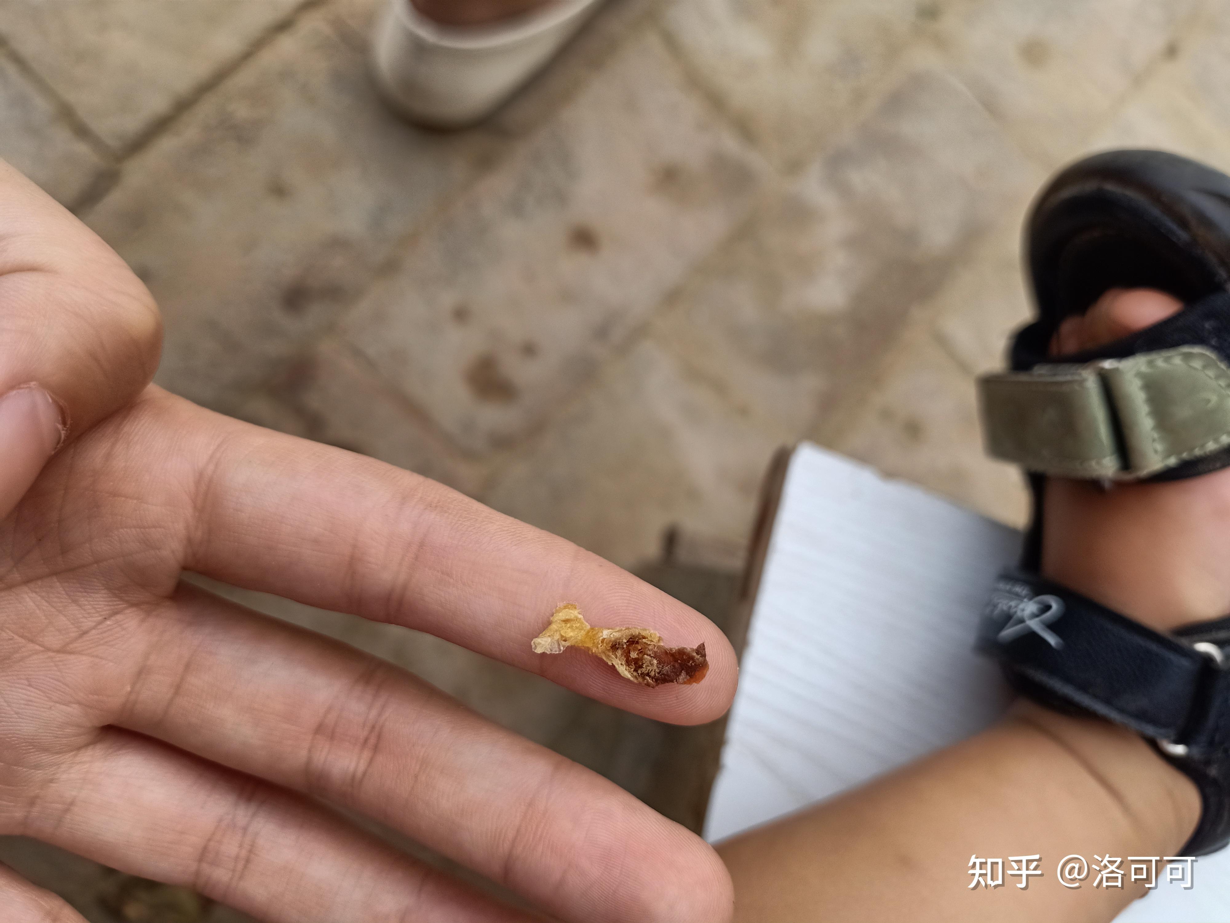 耳屎能大到什么程度? - 知乎