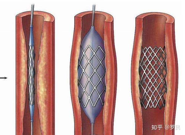 心梗支架图片