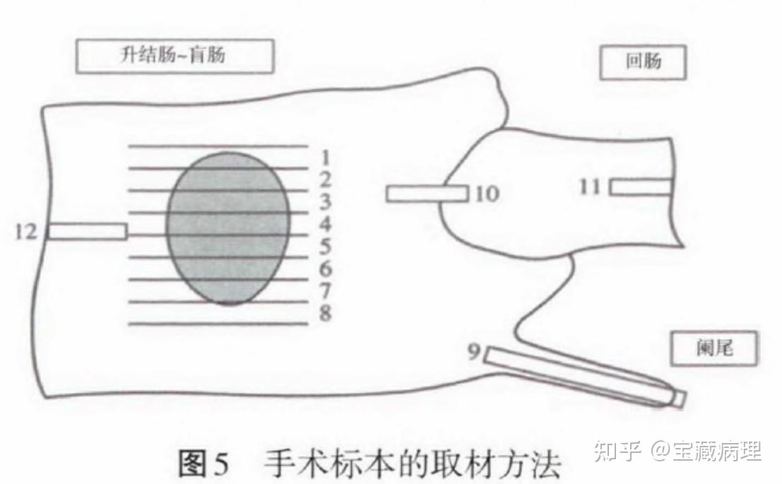 环周切缘图片