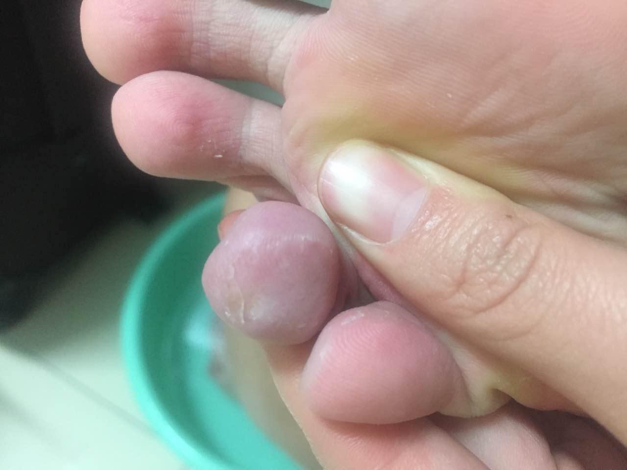 跖疣和鸡眼有什么区别,医学上有没有什么治疗