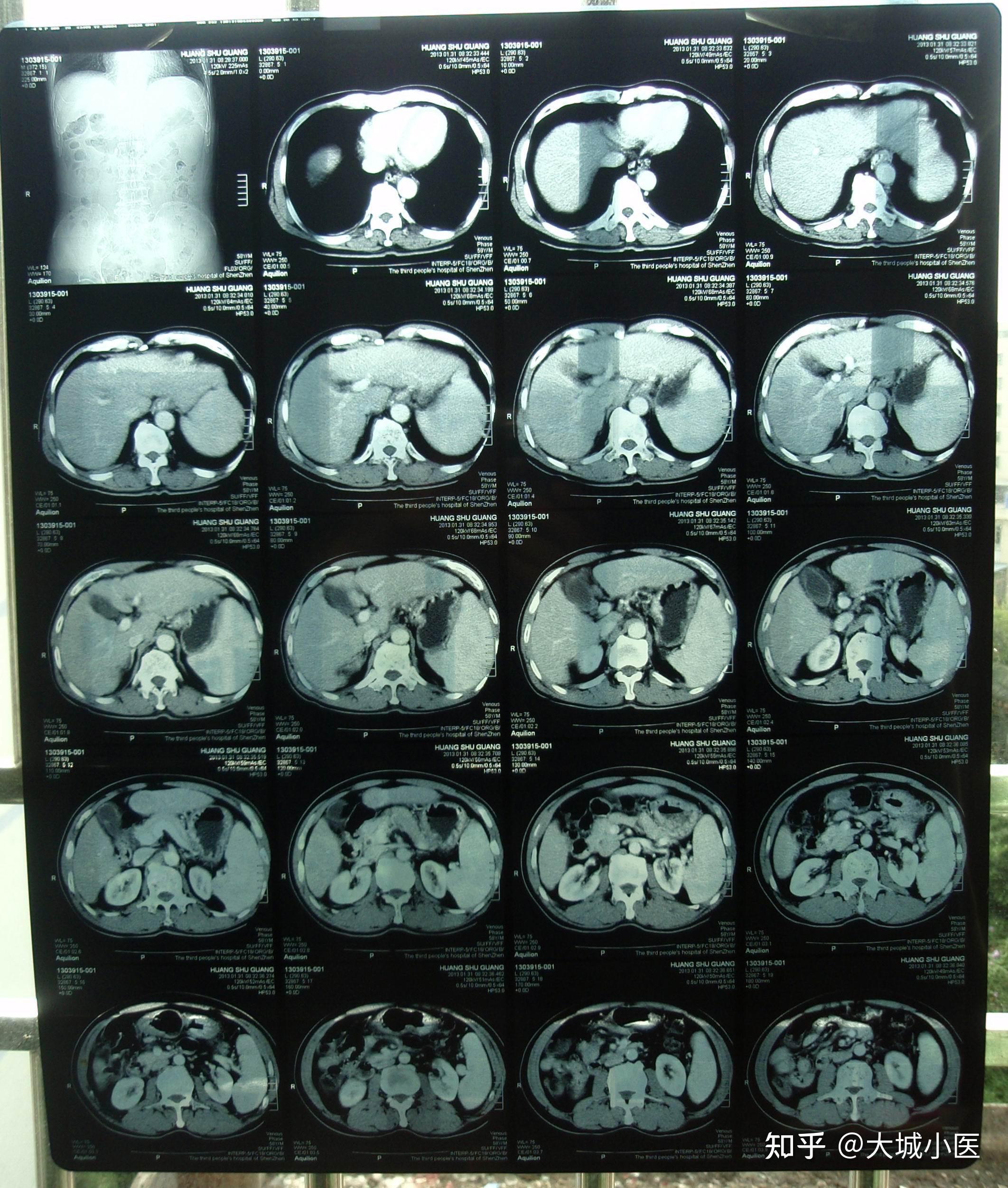 肝尾状叶CT图片