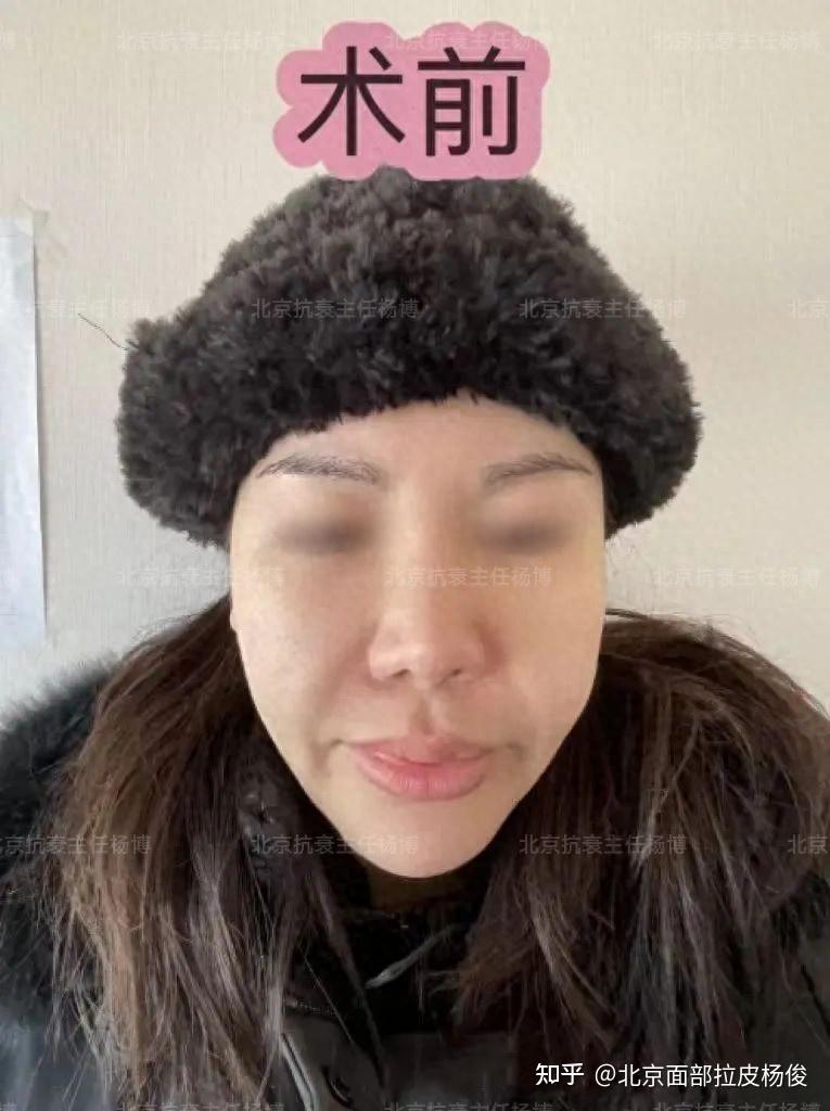 一次线雕、一次小拉皮，43岁女士谈面部提升经历！ - 知乎