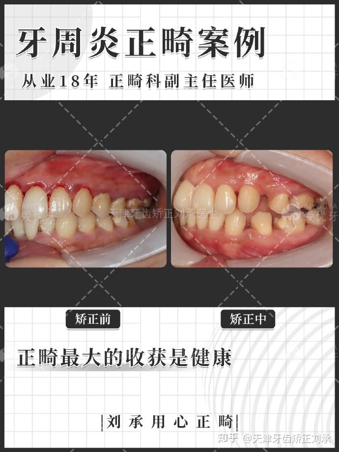 通常針對牙周病的患者醫生會採用不拔牙方案,但是今天講的這個案例