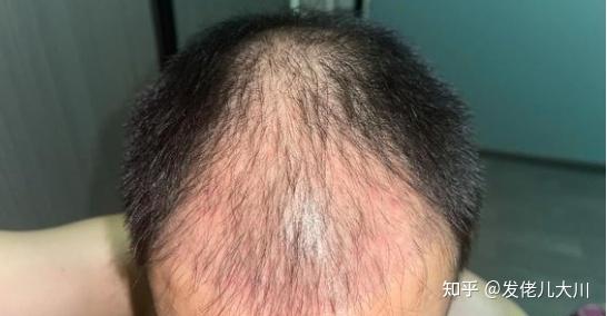 哈尔滨最便宜植发(哈尔滨哪家植发又好价格又低)