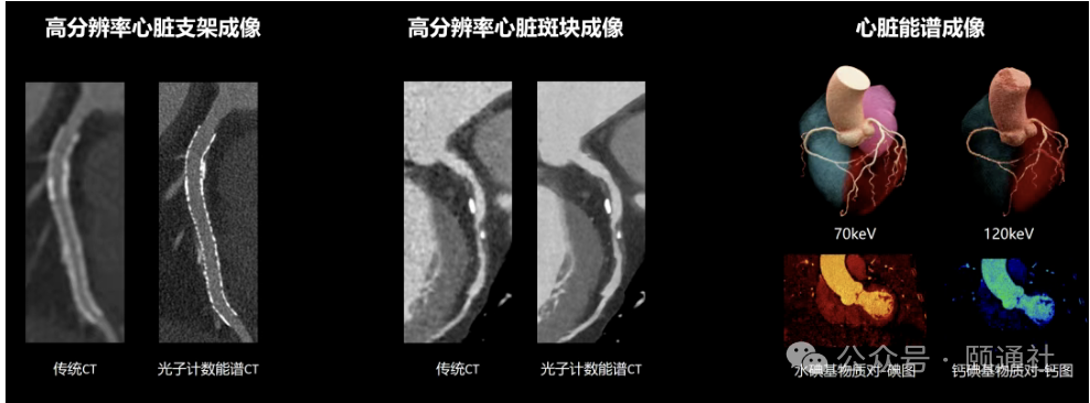 国产高端突破!联影光子计数能谱CT临床落地顶尖医院 - 知乎