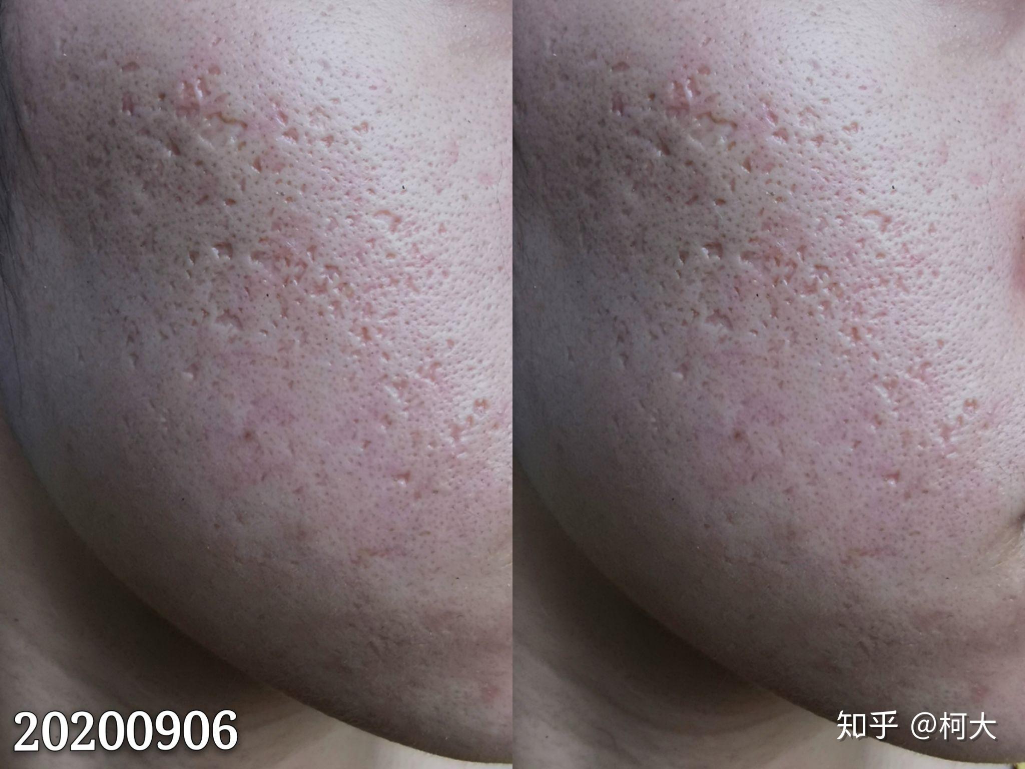 激光祛痘坑真实记录