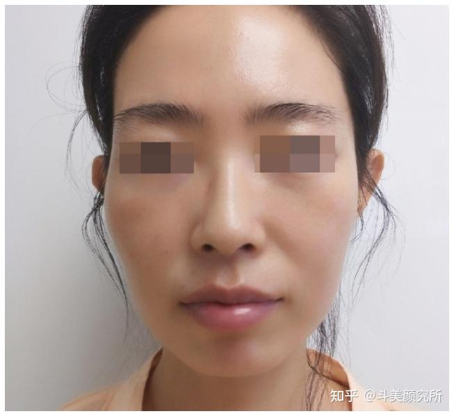 面颊凹陷的原因是什么?如何才能有效改善 - 知乎