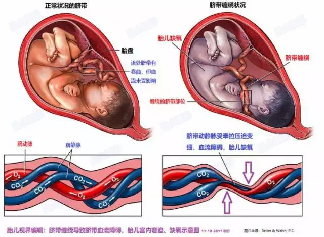 脐带绕颈w型图片欣赏图片