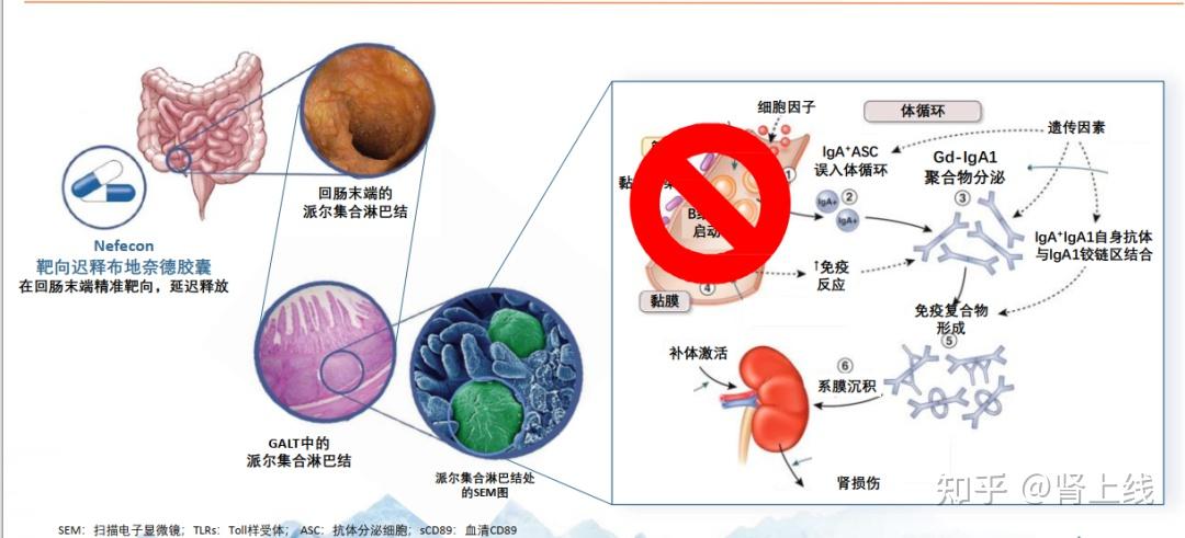 全球首个 iga 肾病靶向治疗药物