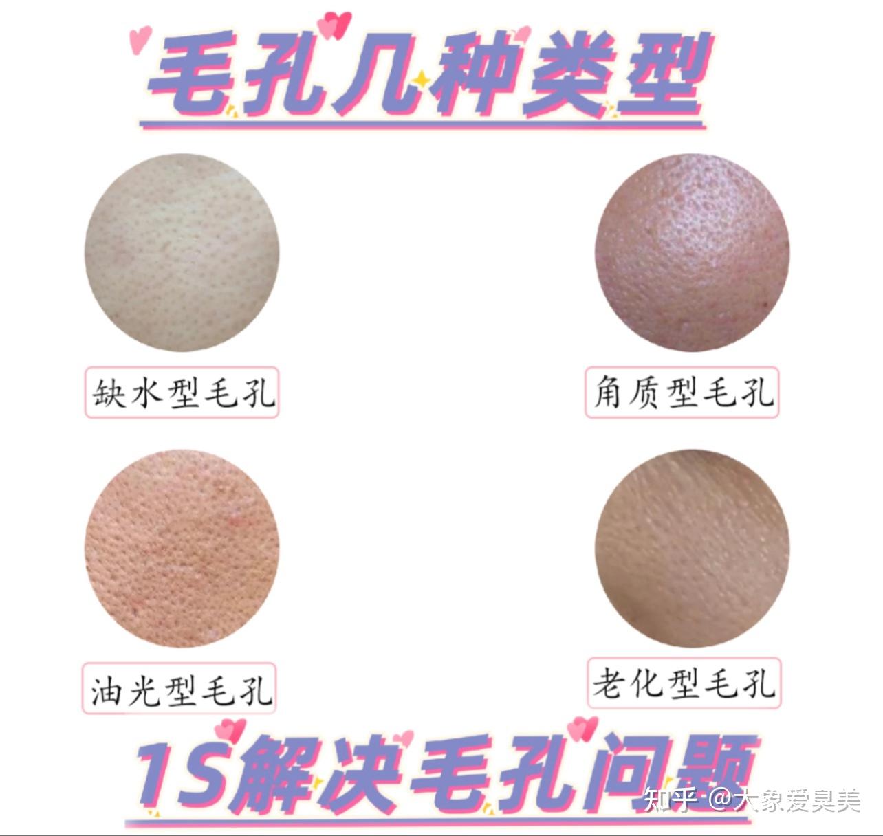 1S带你了解皮肤毛孔粗大,解决毛孔粗大问题 - 知乎