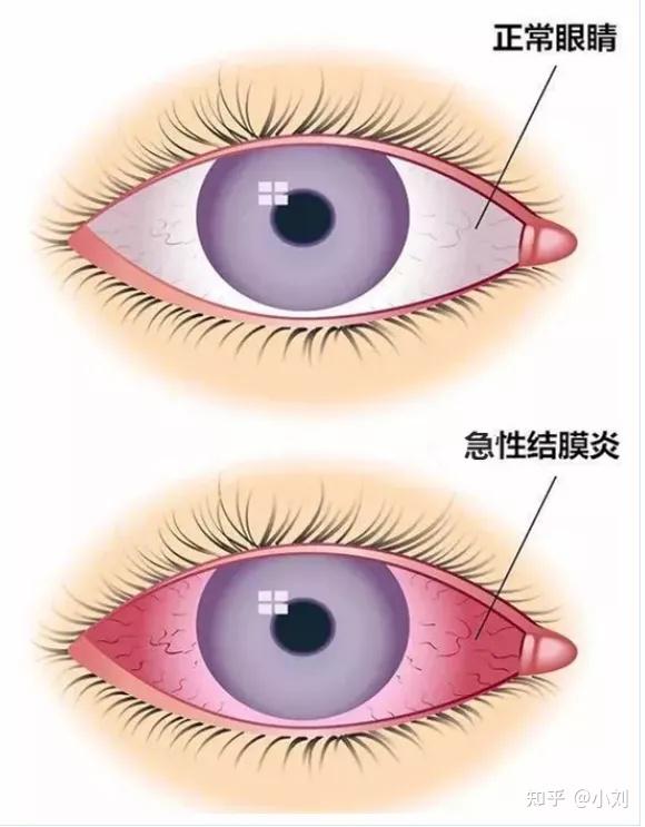 发病特点红眼病是一种病菌接触传染病,医学上称急性结膜炎,主要由细菌