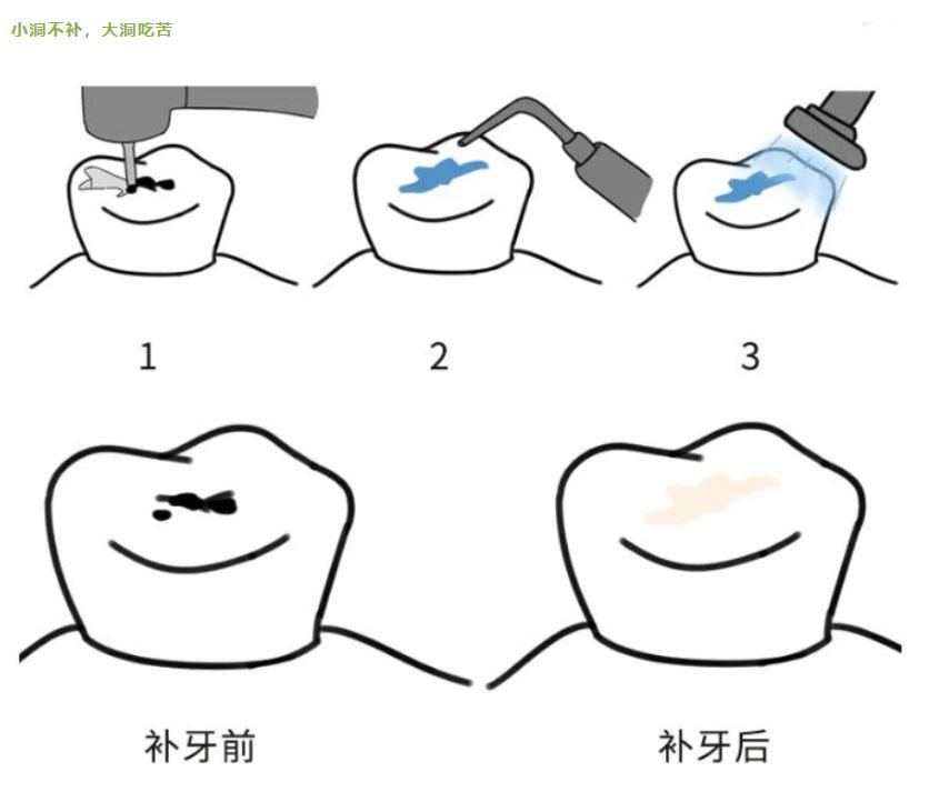 牙齿碰掉了一半,成人,补牙是否可以解决问题?