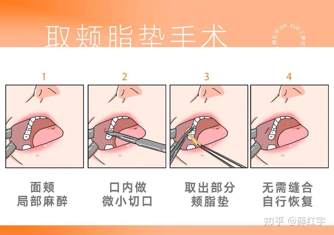 改善颊脂垫肥厚——取颊脂垫口内与口外联合指诊,若能摸到一个可滑动