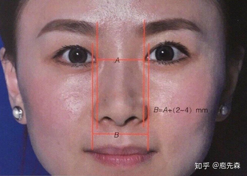 鼻翼缩小手术需要注意些什么