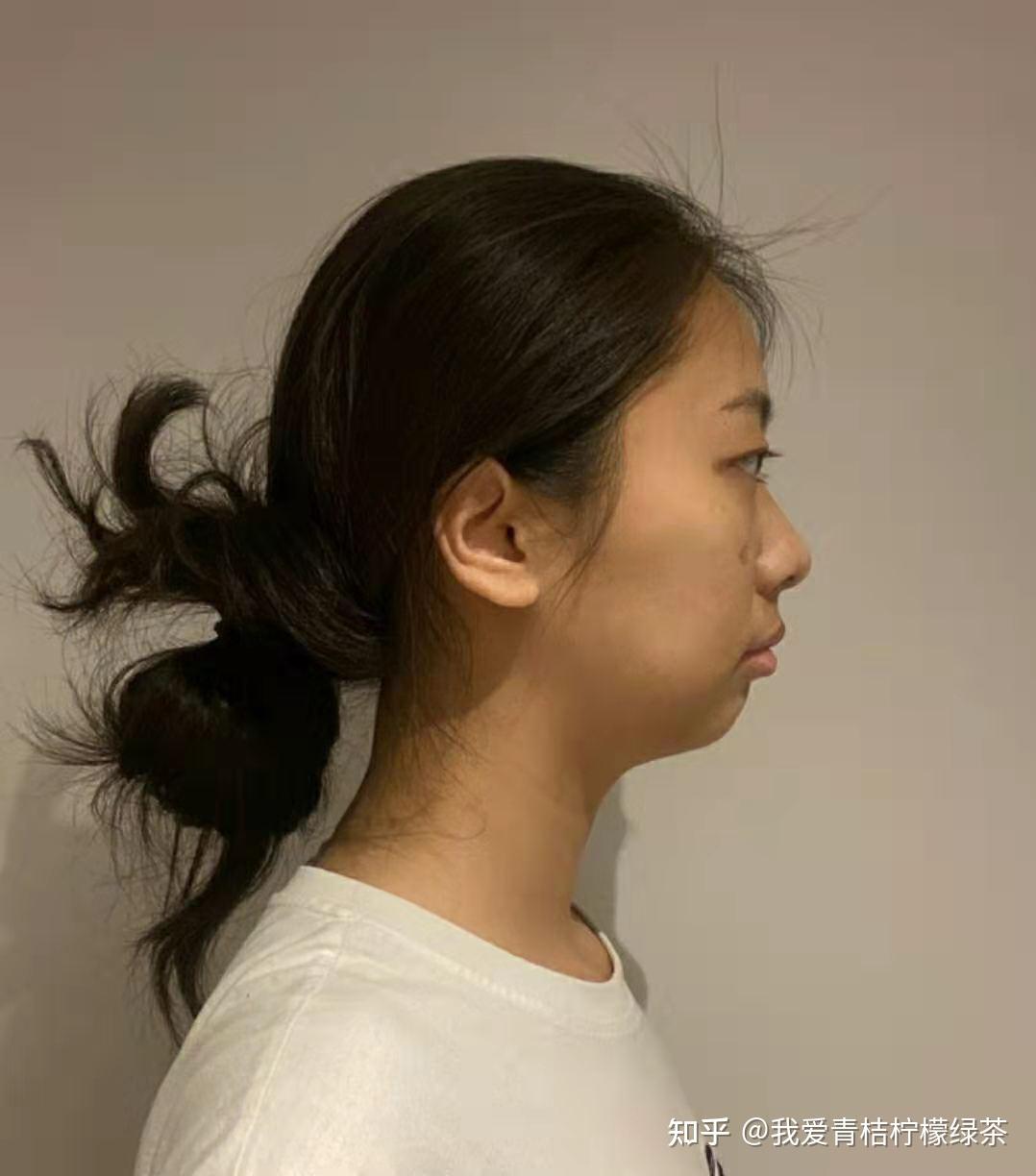 在韩国TS找李相均做完下巴矫正，"月亮脸"蜕变为甜美女孩!,颌面对比照-8682赴韩整形网