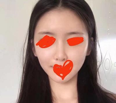 一个月内痘印可以消除吗