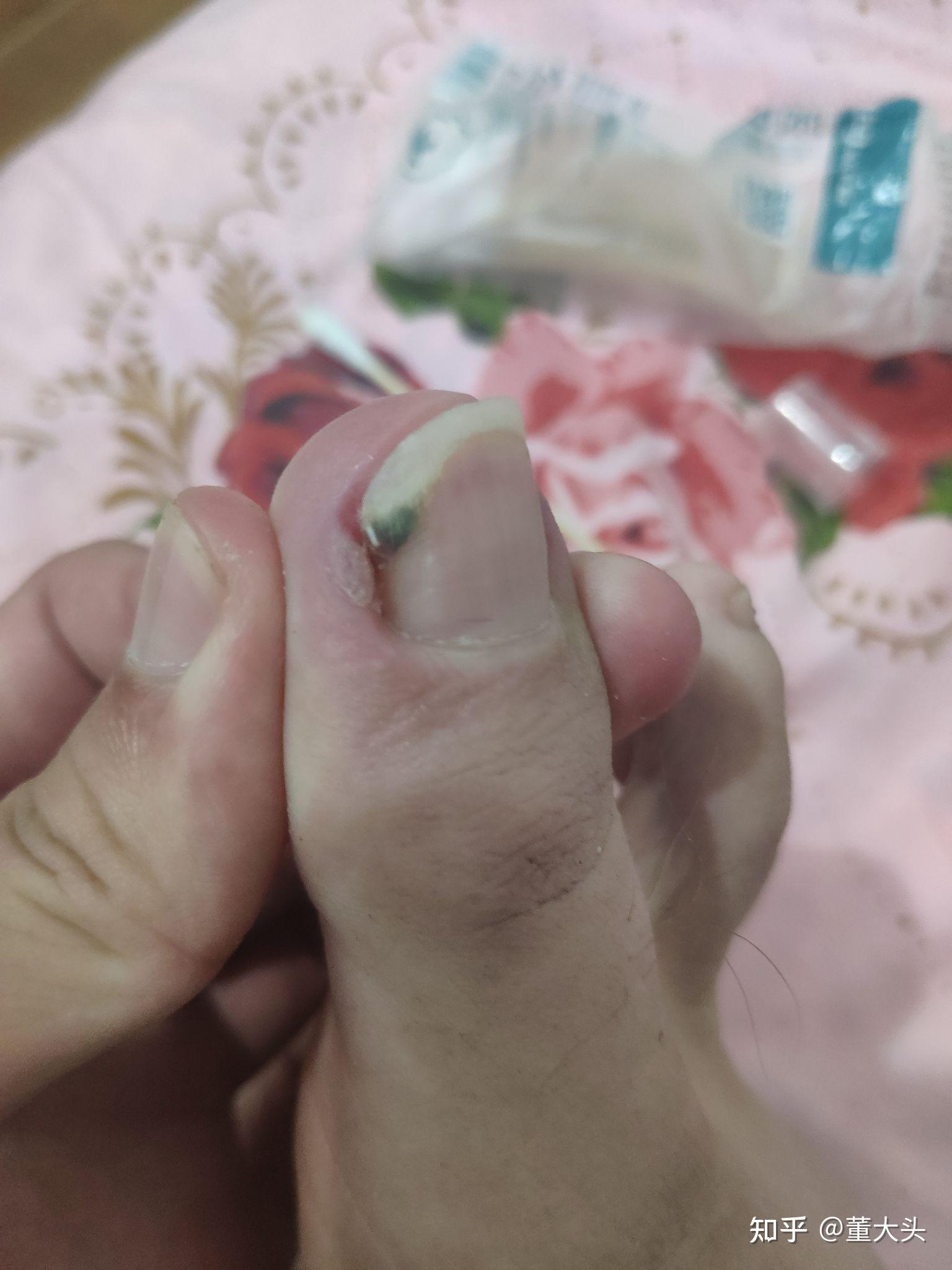 自述:用棉棒和双氧水治疗甲沟炎的过程