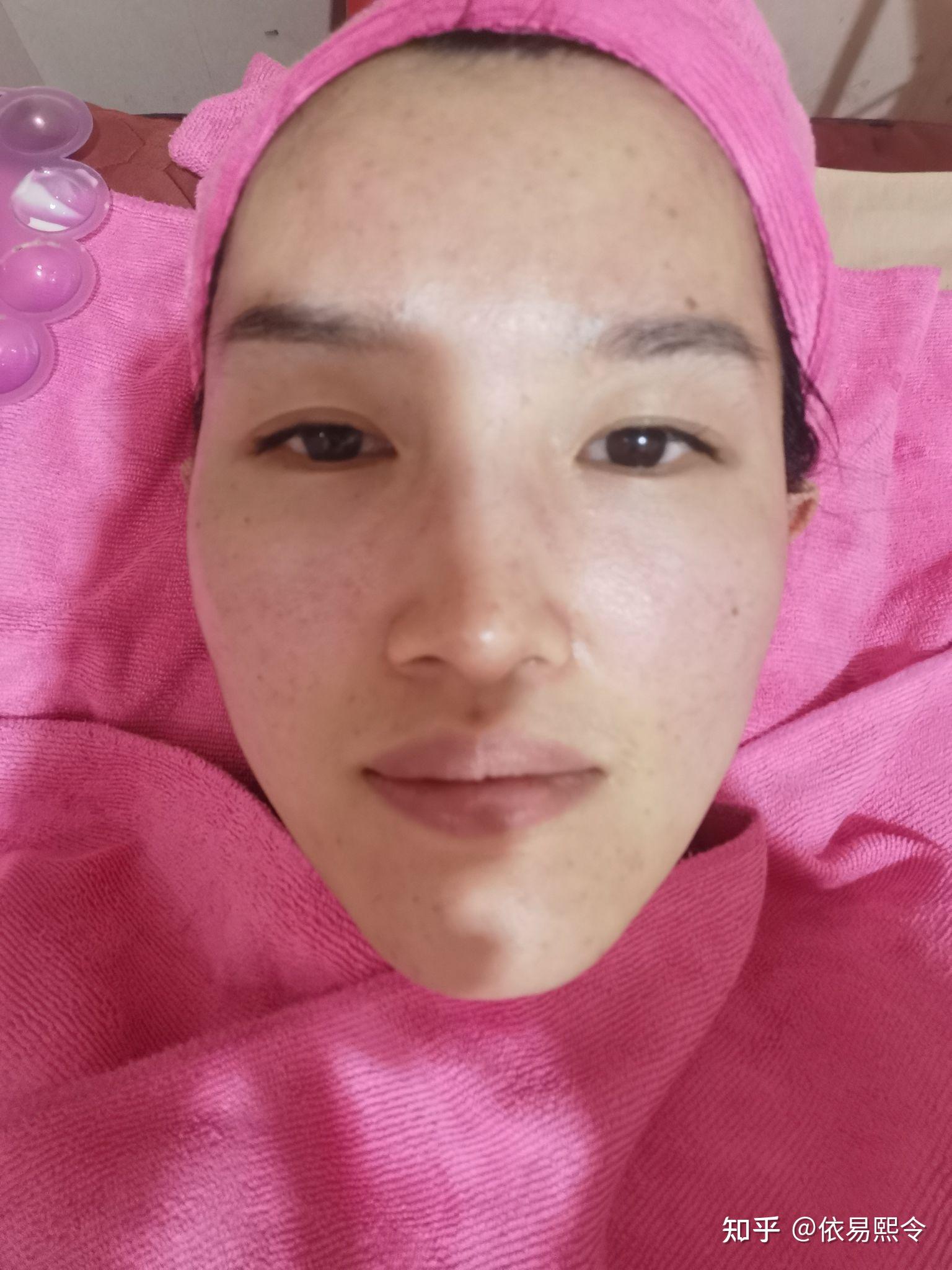 额部骨瘤手术全过程记录(七)～附手术四个半月恢复后生活照片 - 知乎