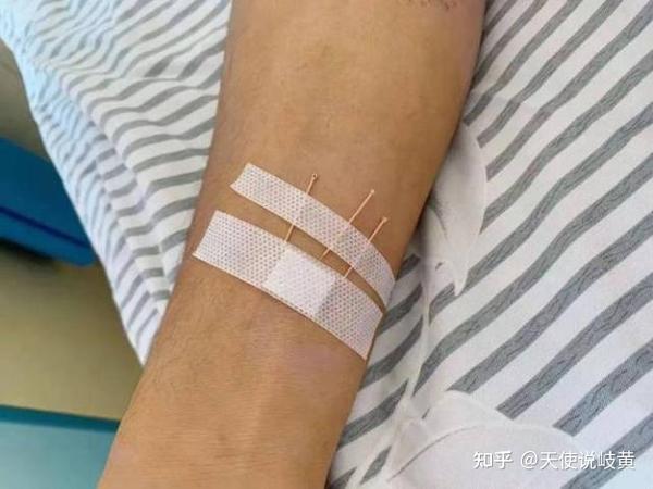 腕踝针中医护理在急性肾绞痛患者中的应用效果分析 - 知乎