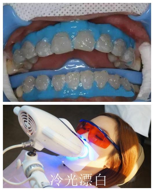 图为"诊所内漂白"的一种方案,冷光漂白